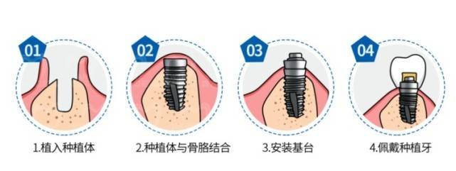 种牙为什么要等三个月，深度解析背后的原因与重要性