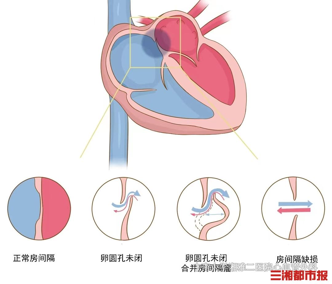 六个月宝宝卵圆孔未闭，了解、关注与应对