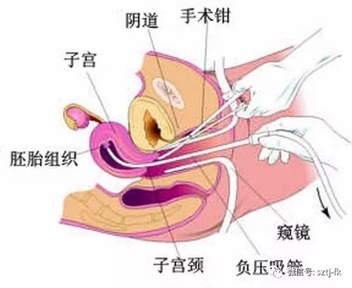 引产半个月后同房的风险与后果